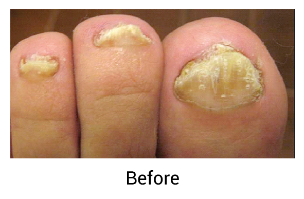 before-(fungal-nails)