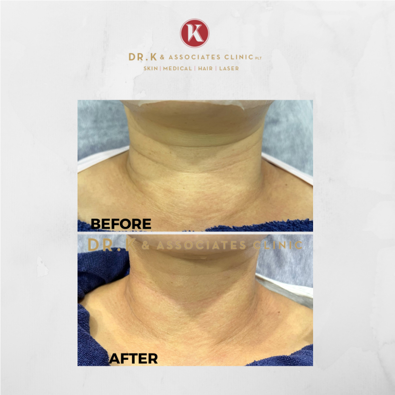 Before and After Dermal Filler Injections​ in Malaysia: Neck