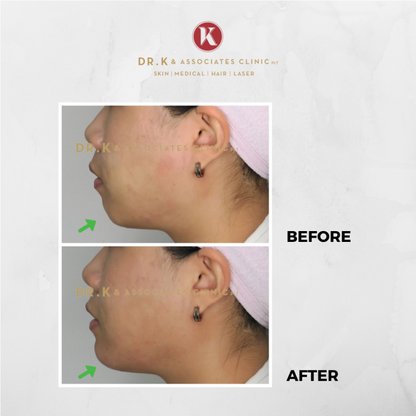 Before and After Dermal Filler Injections​ in Malaysia: Chin