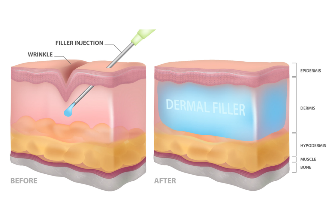 How Do Dermal Filler in Malaysia Work?​