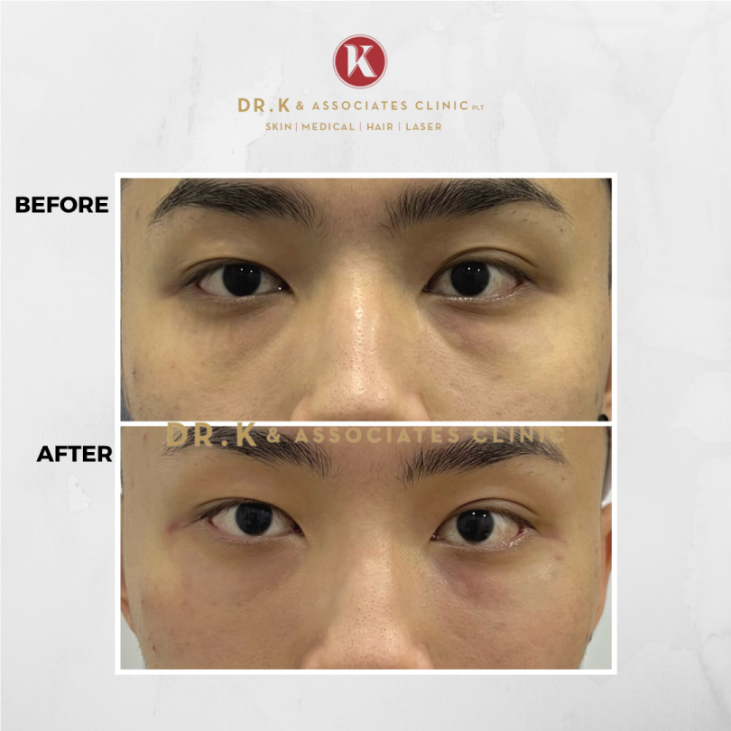 Before and After Dermal Filler Injections​ in Malaysia: Dark Eye Circles