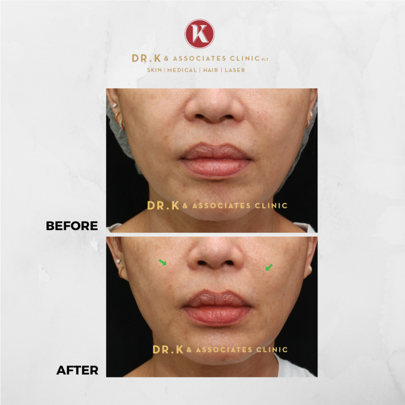 Before and After Fotona 4D Laser Treatment: Face Lift 2
