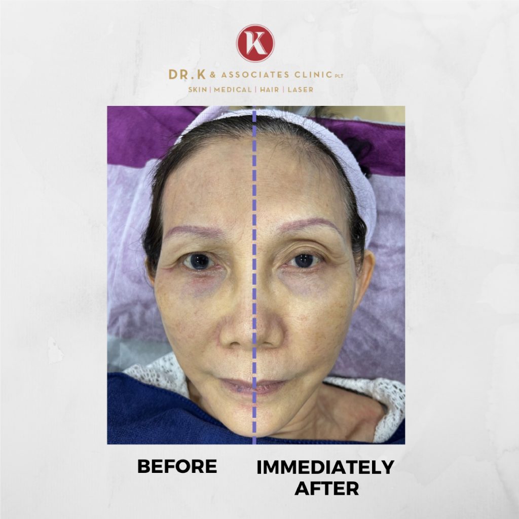Before and After Fotona 4D Laser Treatment: Face Lift