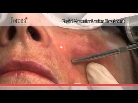 Vascular Lesion Laser Treatment