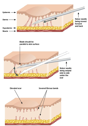 Scar Removal Treatment in Malaysia: Subcision