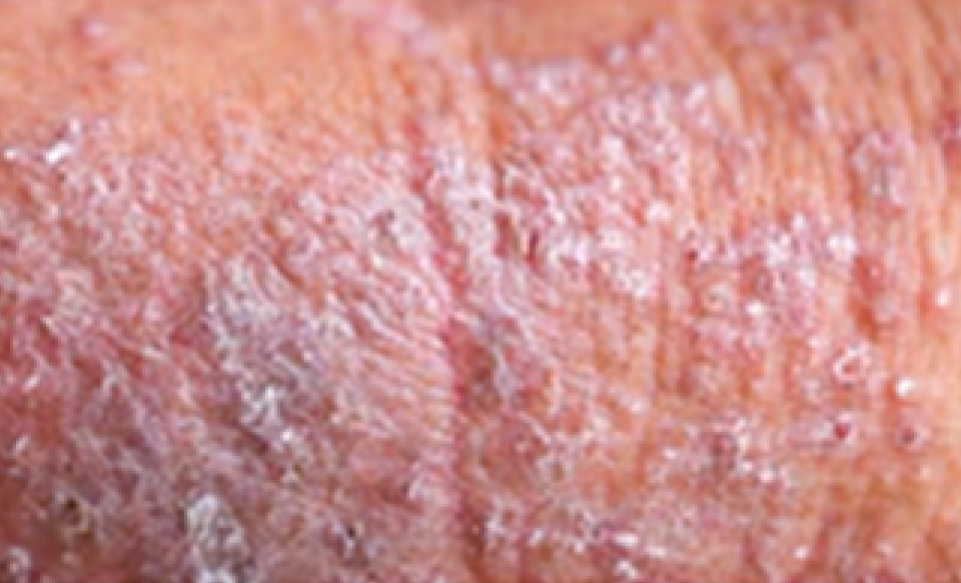 Types of Eczema that Requires Treatment: Atopic Dermatitis