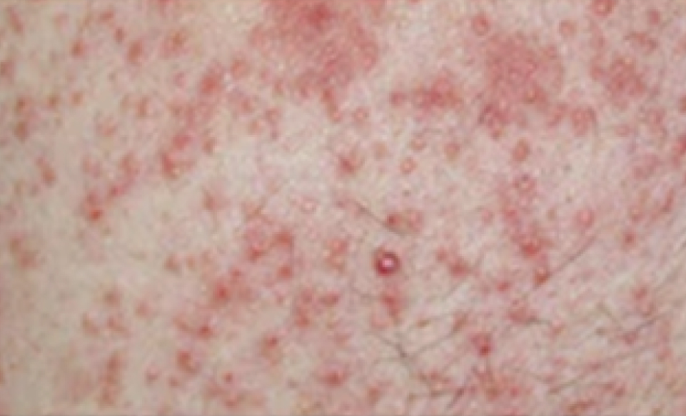 Types of Eczema that Requires Treatment: Contact Dermatitis