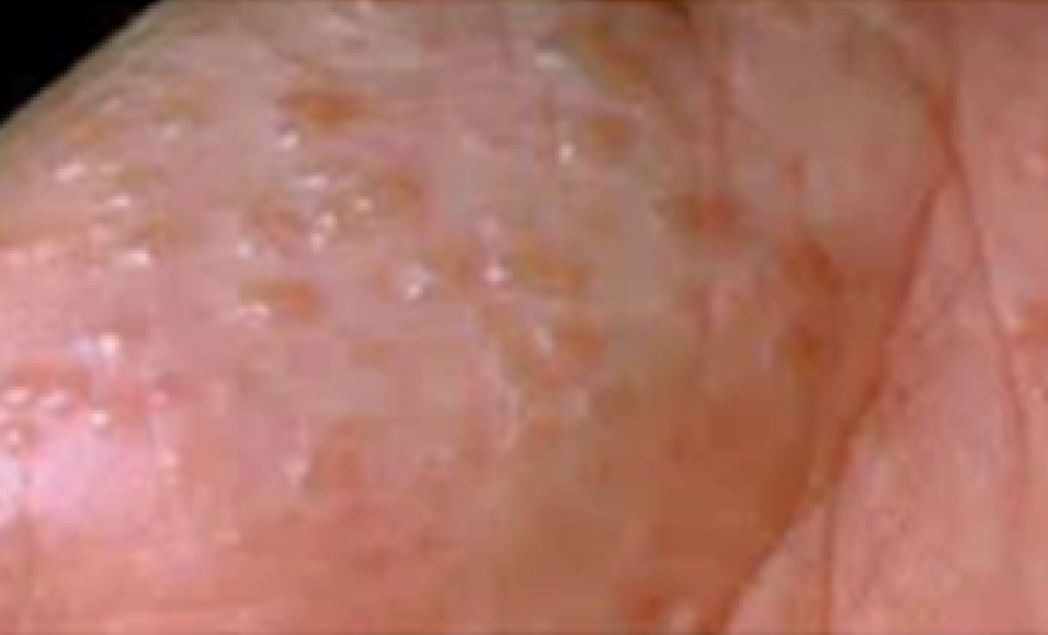 Types of Eczema that Requires Treatment: Dyshidrotic Eczema