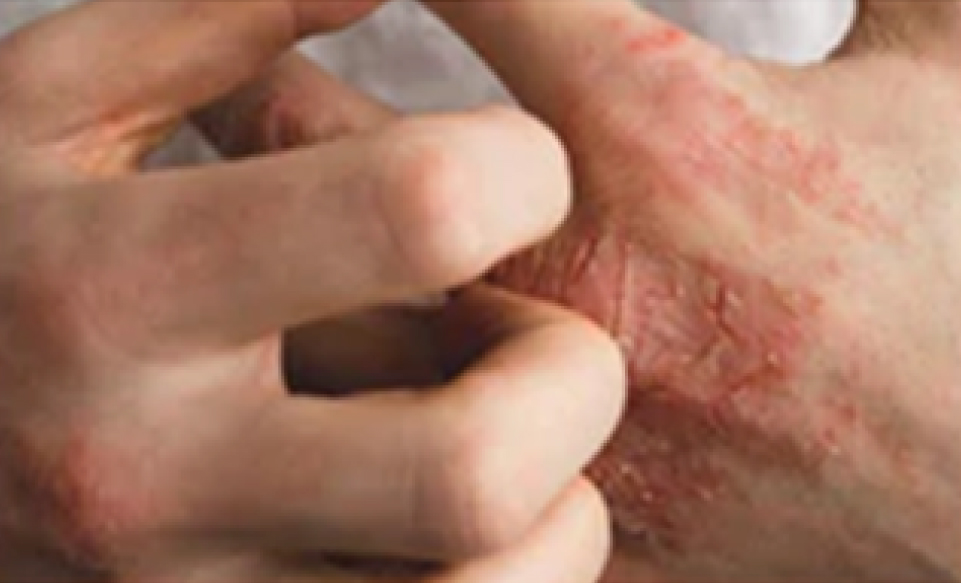 Types of Eczema that Requires Treatment: Hand Eczema