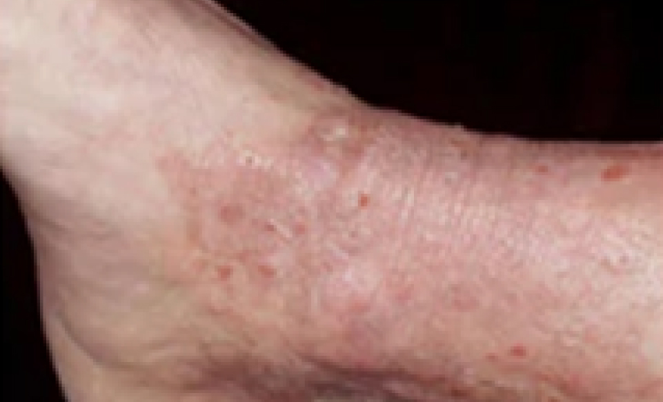 Types of Eczema that Requires Treatment: Neurodermatitis