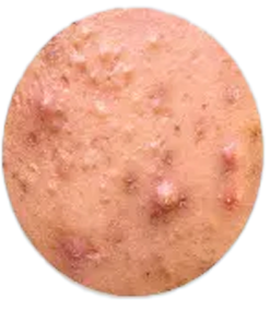Common Types of Acne​: Nodular acne