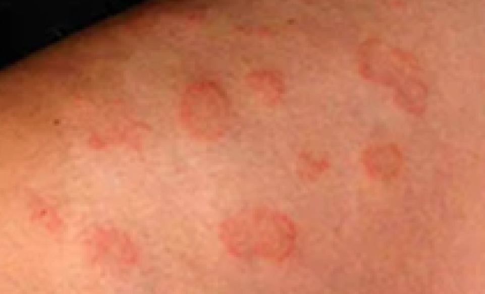 Types of Eczema that Requires Treatment: Nummular Eczema
