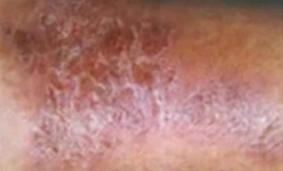 Types of Eczema that Requires Treatment: Stasis Dermatitis