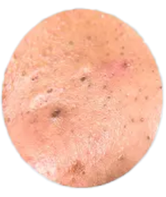 Common Types of Acne​: Blackheads