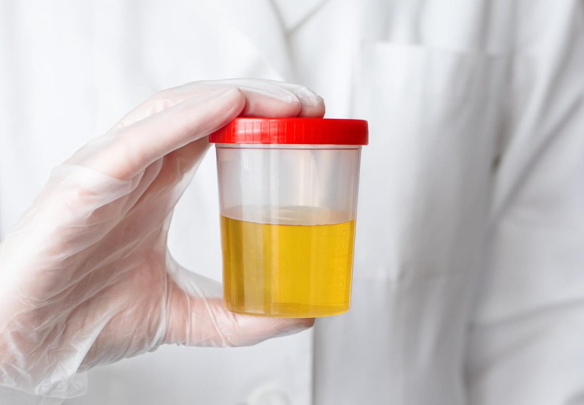 STD Screening Methods: Urine Tests