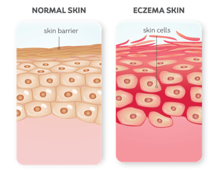 Eczema Treatment: What is Eczema?