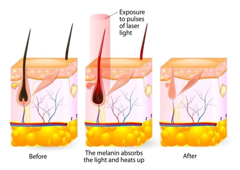 How Does Laser Hair Removal Treatment in Malaysia Work? ​