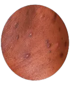 Common Types of Acne​: papules