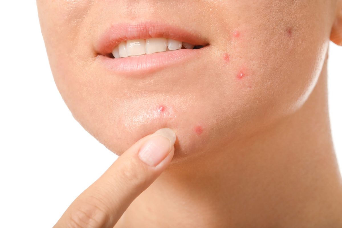 Introduction to Acne and its Treatment Plans ​